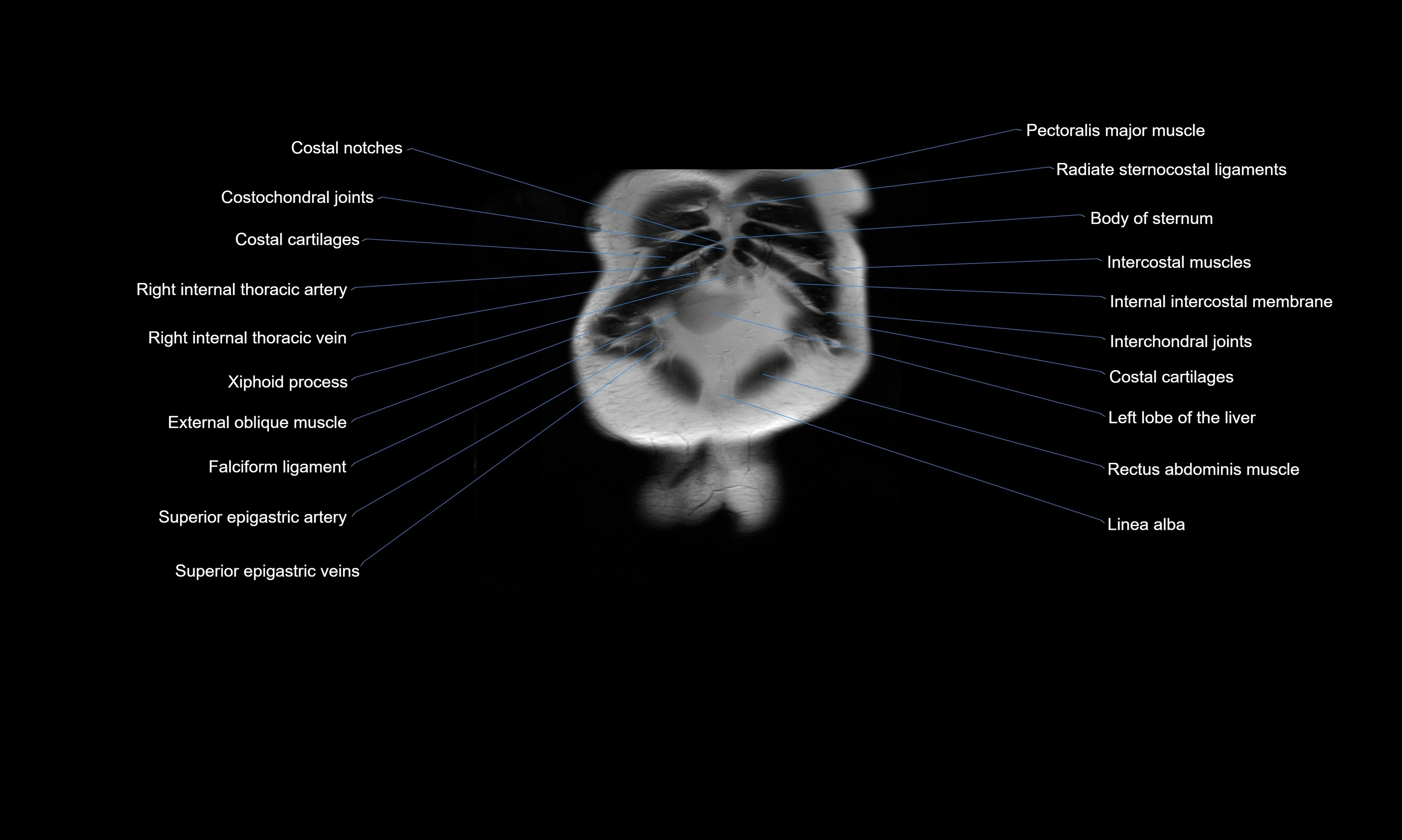 MRI Abdomen axial cross sectional anatomy radiology  image-img-00001-00006.webp